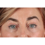 Eyelid Surgery Before & After Patient #3475