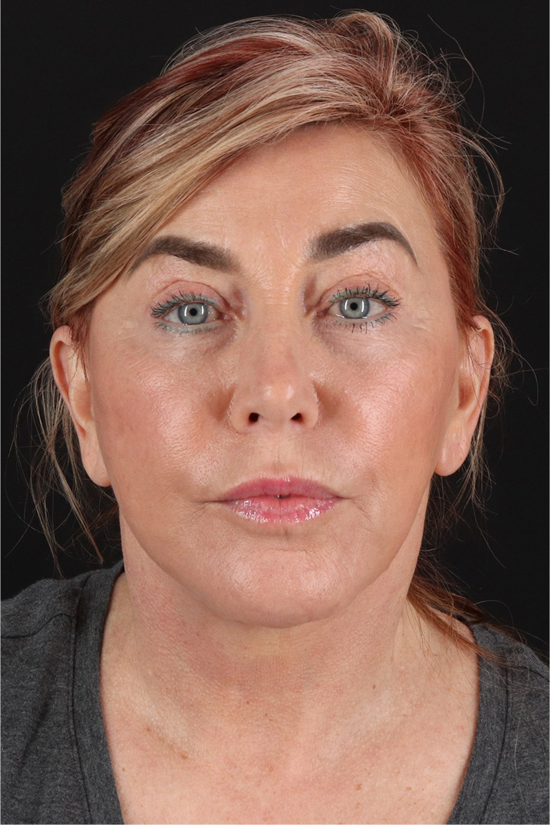 Neck Lift Before & After Patient #3476