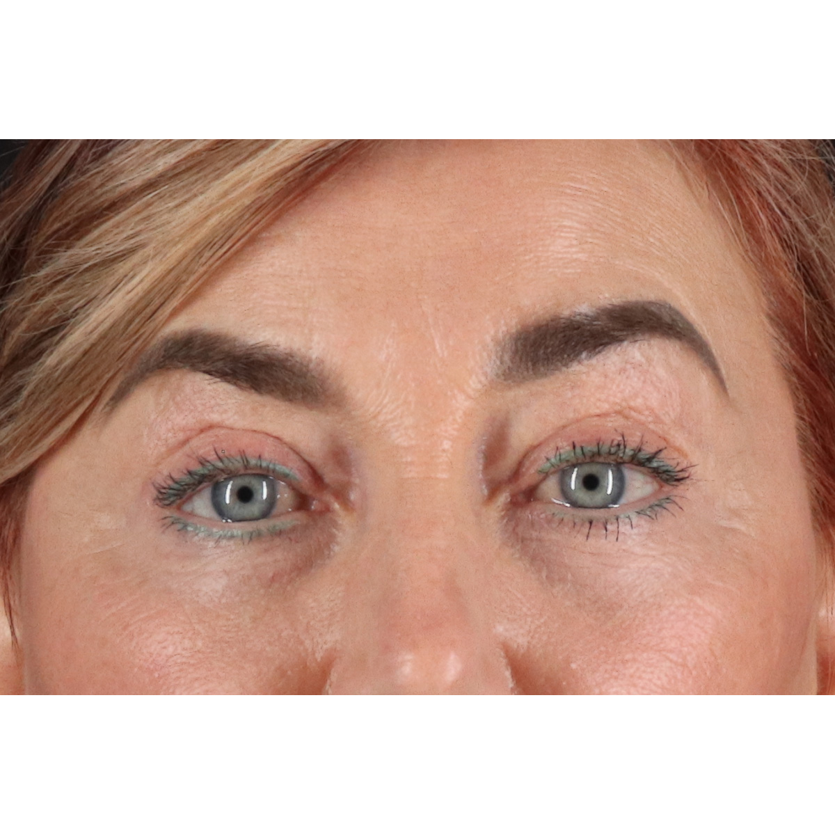 Eyelid Surgery Before & After Patient #3475