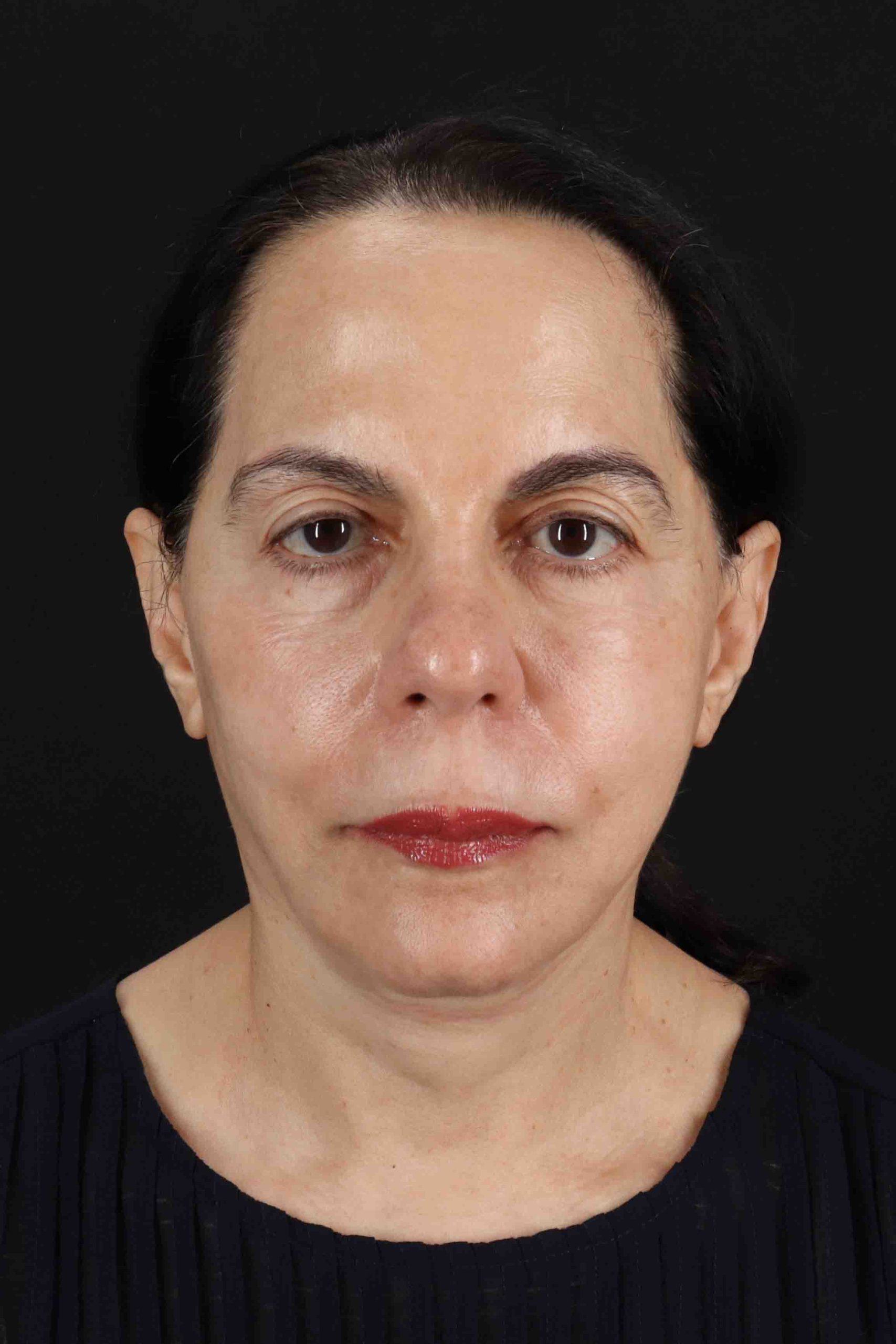 Structural Fat Grafting Before & After Patient #3645