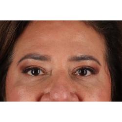 Eyelid Surgery Before & After Patient #3008
