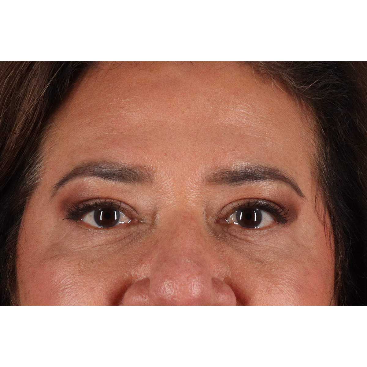 Eyelid Surgery Before & After Patient #3008