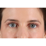 Eyelid Surgery Before & After Patient #3570