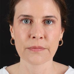 Structural Fat Grafting Before & After Patient #3647