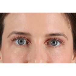 Eyelid Surgery Before & After Patient #3570