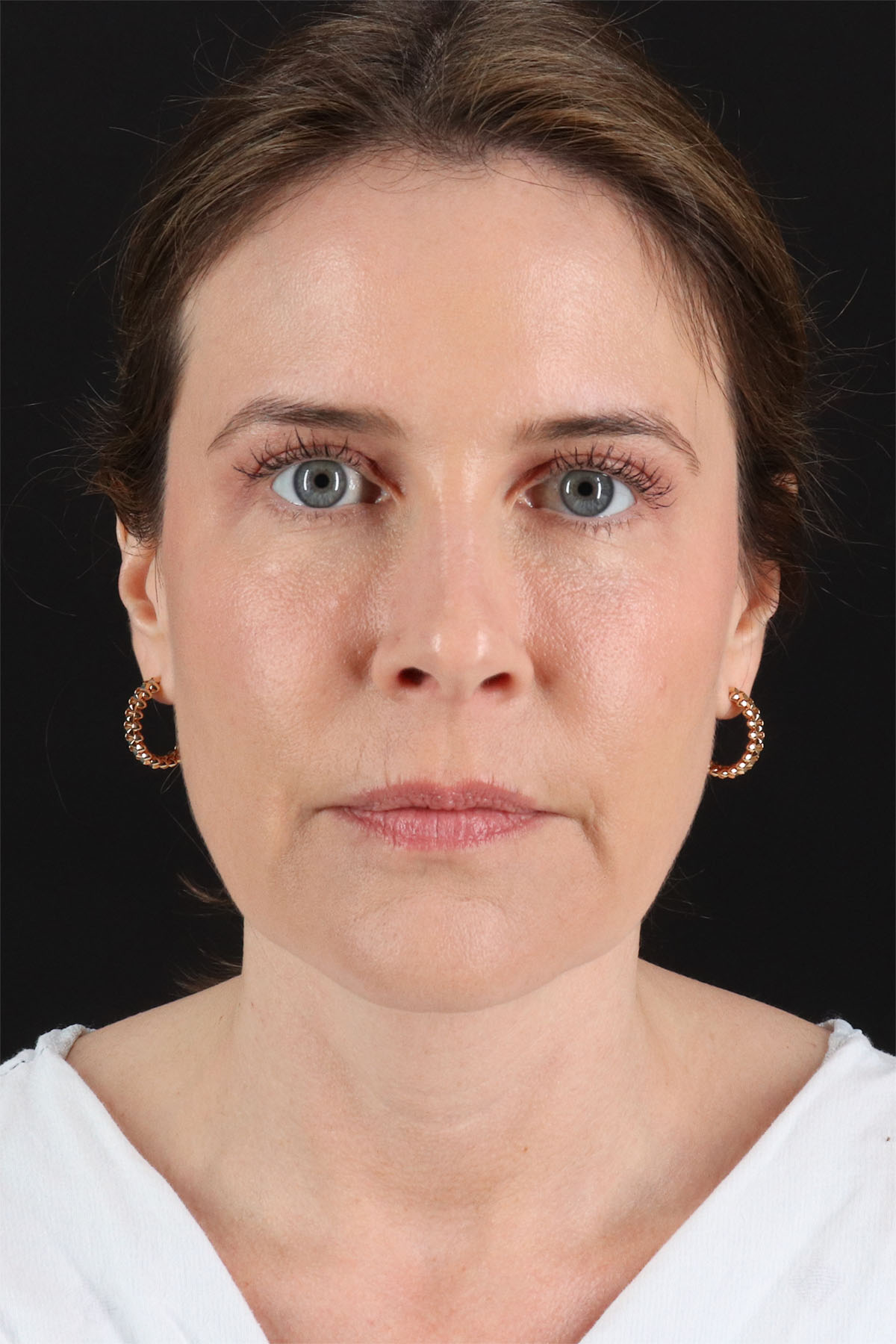 Structural Fat Grafting Before & After Patient #3647