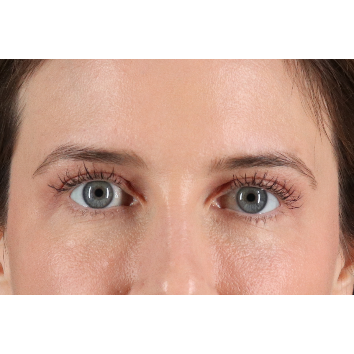Eyelid Surgery Before & After Patient #3570