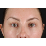 Brow Lift Before & After Patient #3111