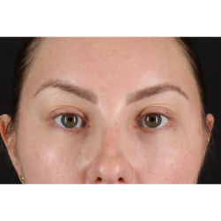 Brow Lift Before & After Patient #3111
