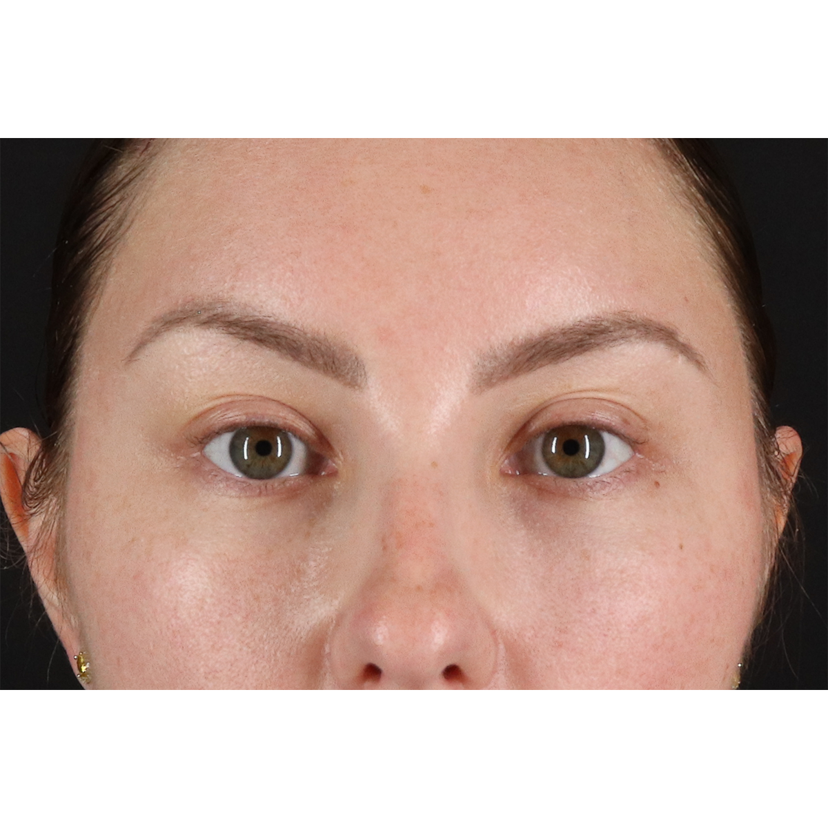 Brow Lift Before & After Patient #3111