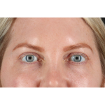 Eyelid Surgery Before & After Patient #3112