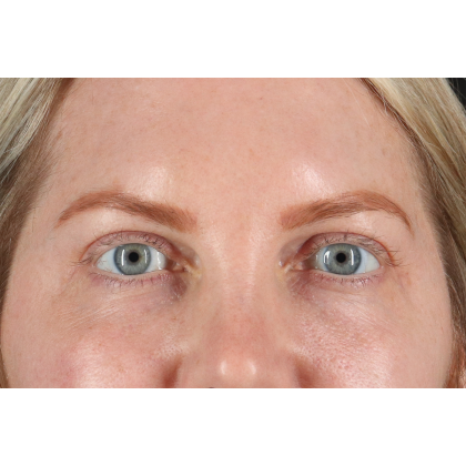 Eyelid Surgery Before & After Patient #3112