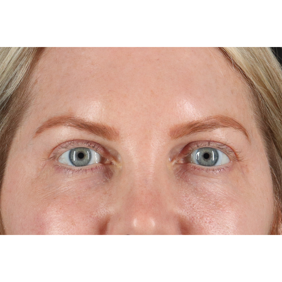 Eyelid Surgery Before & After Patient #3112