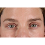 Eyelid Surgery Before & After Patient #3571