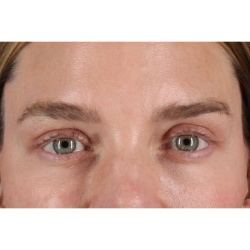 Eyelid Surgery Before & After Patient #3571