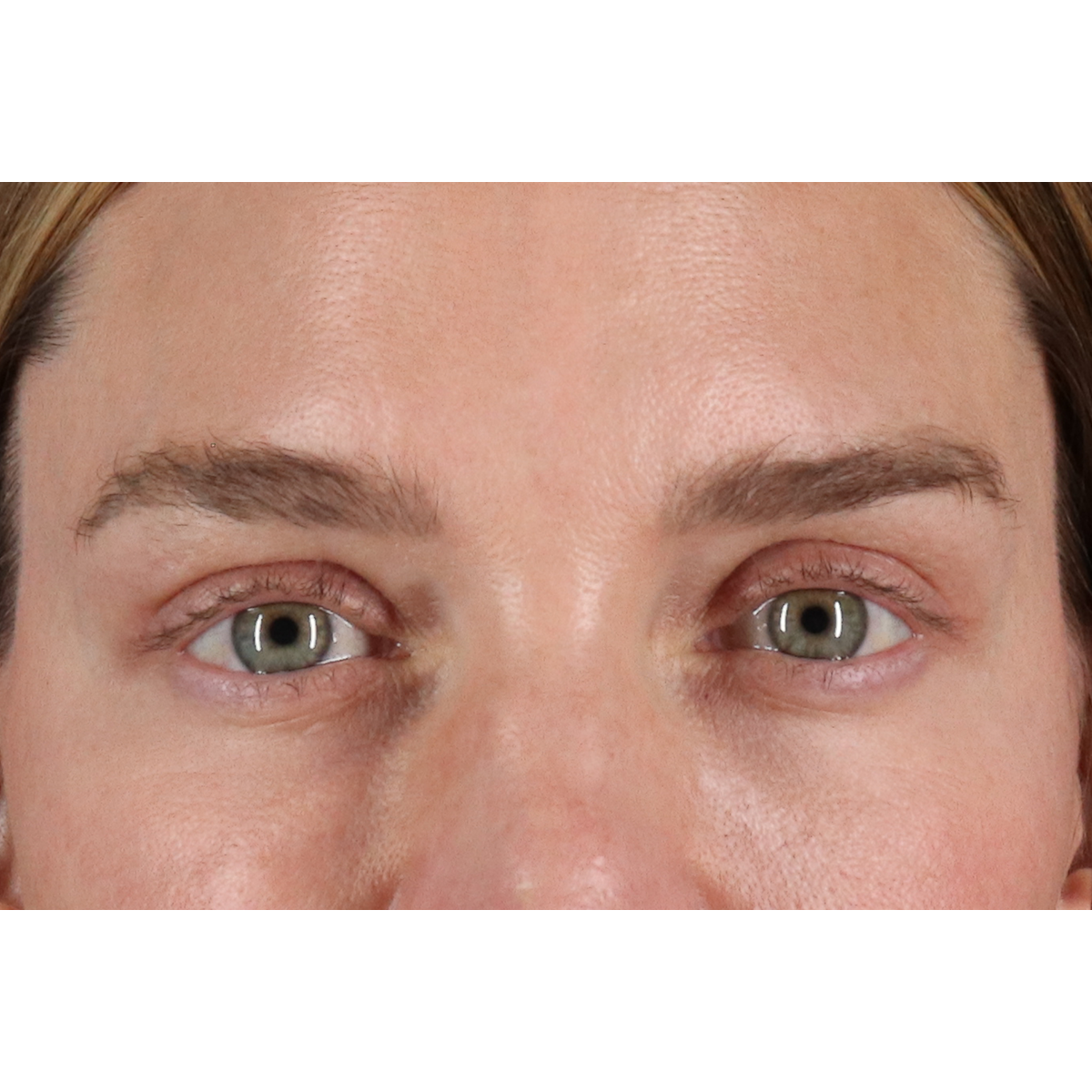 Eyelid Surgery Before & After Patient #3571