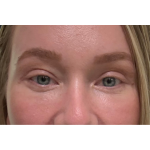 Eyelid Surgery Before & After Patient #3454