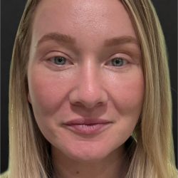 Laser Before & After Patient #3455