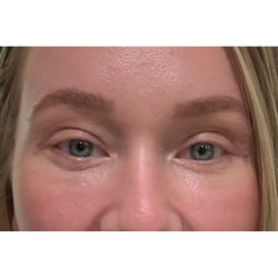 Eyelid Surgery Before & After Patient #3454