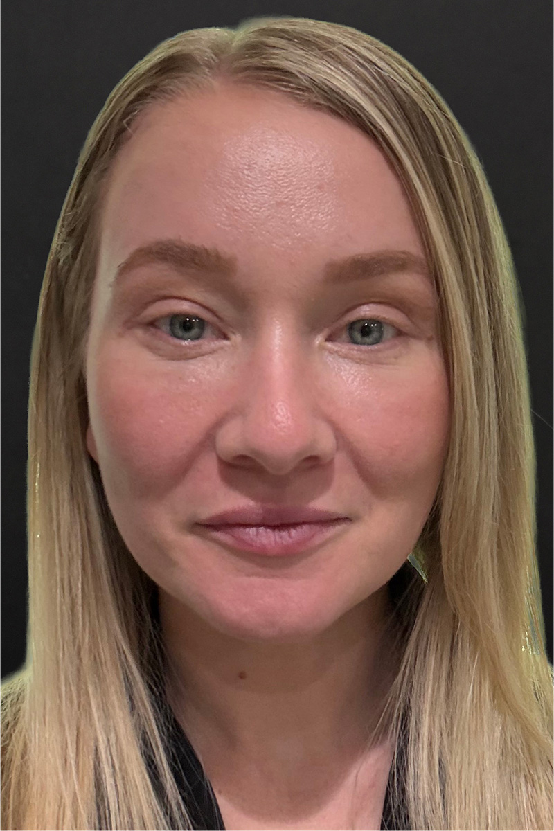Laser Before & After Patient #3455