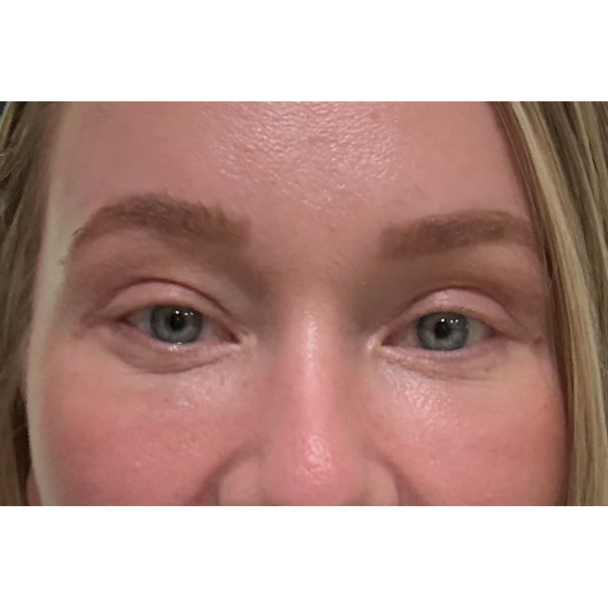 Eyelid Surgery Before & After Patient #3454