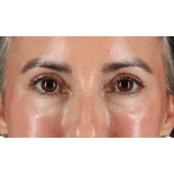 Eyelid Surgery Before & After Patient #3356