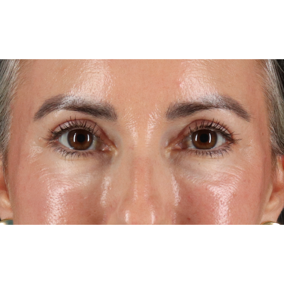 Eyelid Surgery Before & After Patient #3356