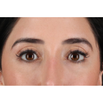 Eyelid Surgery Before & After Patient #3358