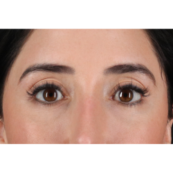 Eyelid Surgery Before & After Patient #3358