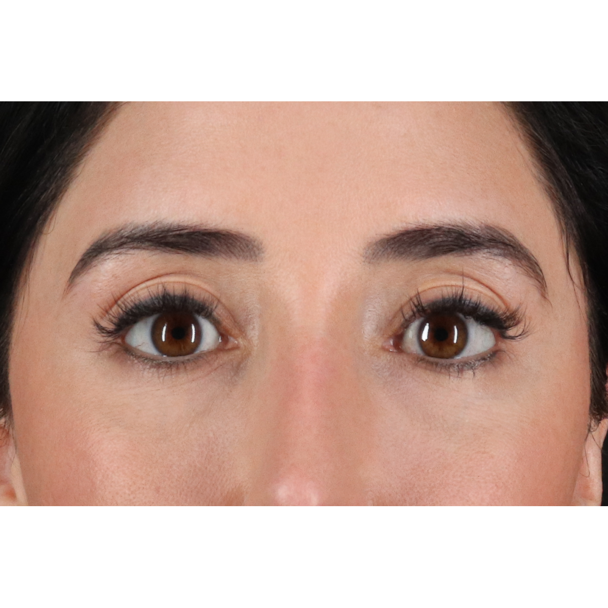 Eyelid Surgery Before & After Patient #3358