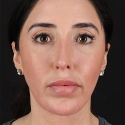 Structural Fat Grafting Before & After Patient #3649