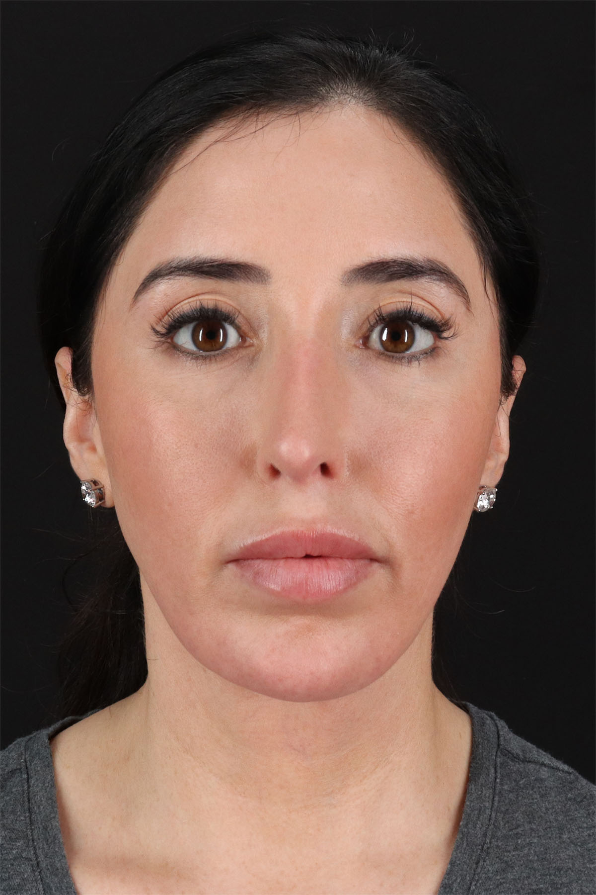 Structural Fat Grafting Before & After Patient #3649