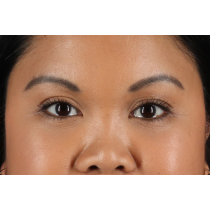 Brow Lift Before & After Patient #3114