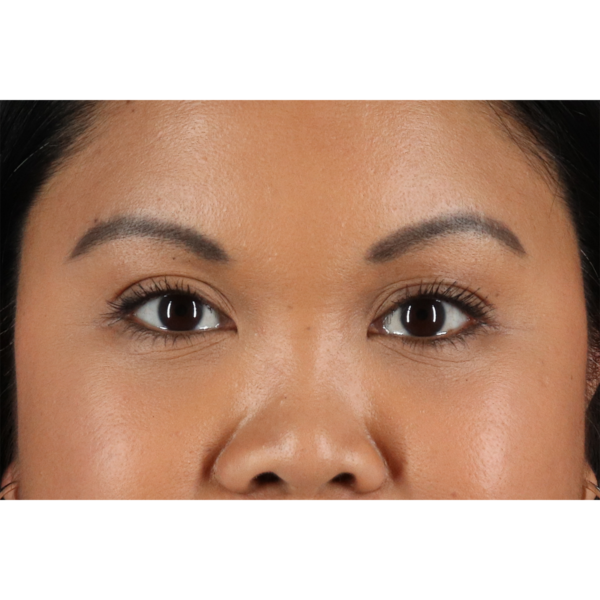 Brow Lift Before & After Patient #3114