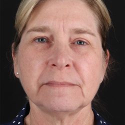 CO2 Laser Before & After Patient #3116