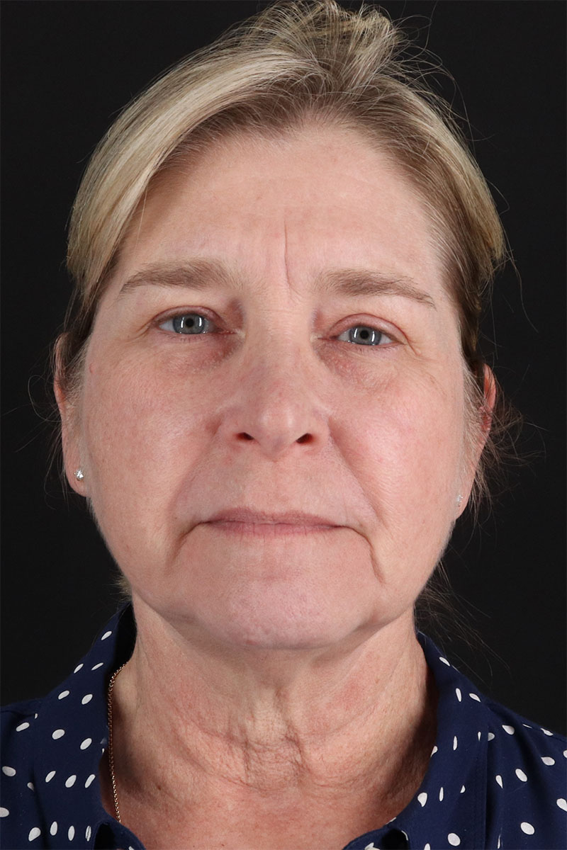 CO2 Laser Before & After Patient #3116