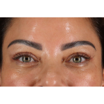 Eyelid Surgery Before & After Patient #3360