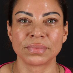 Laser Before & After Patient #3359