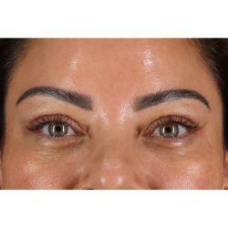 Eyelid Surgery Before & After Patient #3360