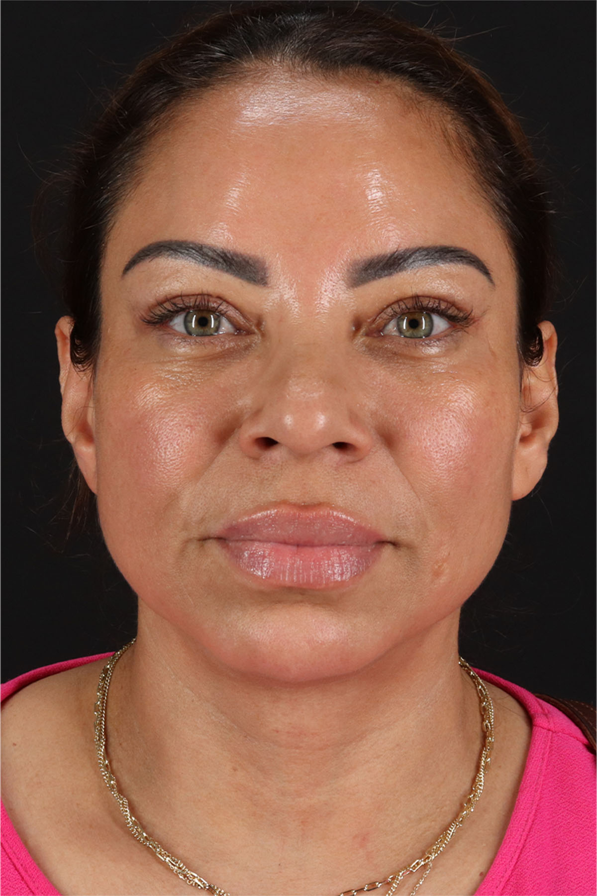 Laser Before & After Patient #3359