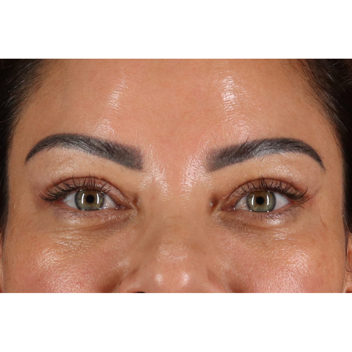 Eyelid Surgery Before & After Patient #3360