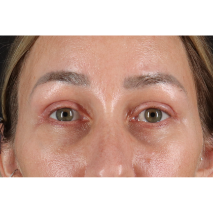 Eyelid Surgery Before & After Patient #3361