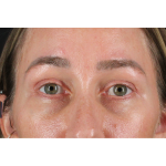 Eyelid Surgery Before & After Patient #3361
