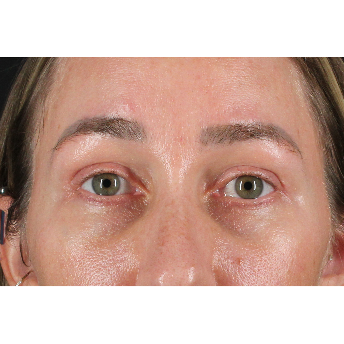 Eyelid Surgery Before & After Patient #3361