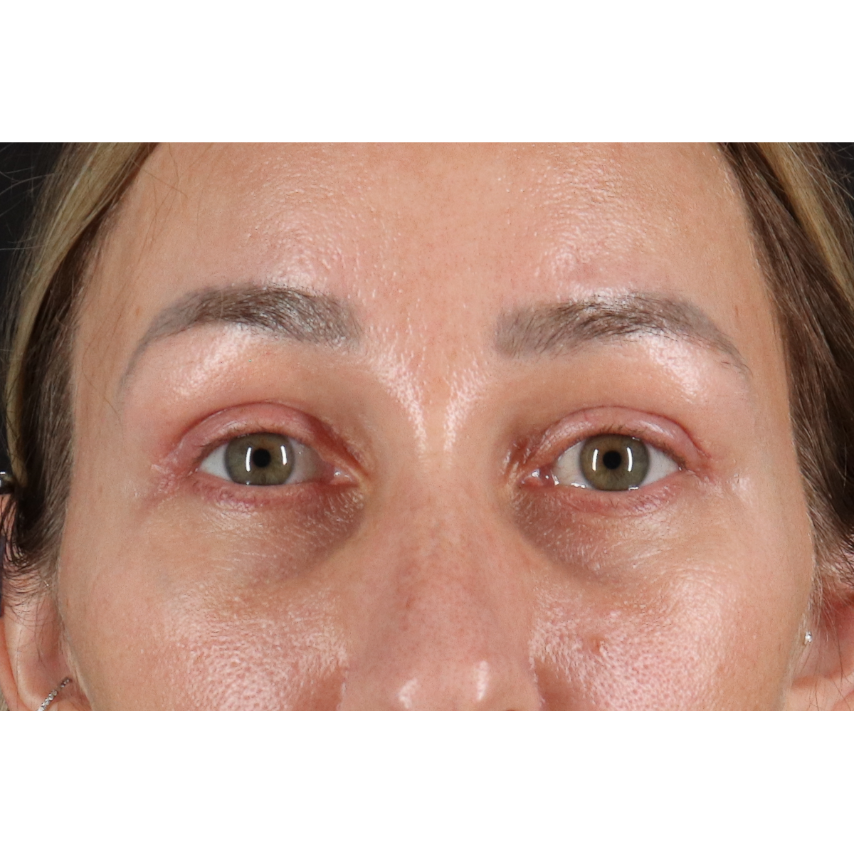 Eyelid Surgery Before & After Patient #3361