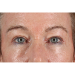 Eyelid Surgery Before & After Patient #3363
