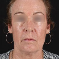 Laser Before & After Patient #3362