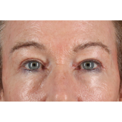 Eyelid Surgery Before & After Patient #3363