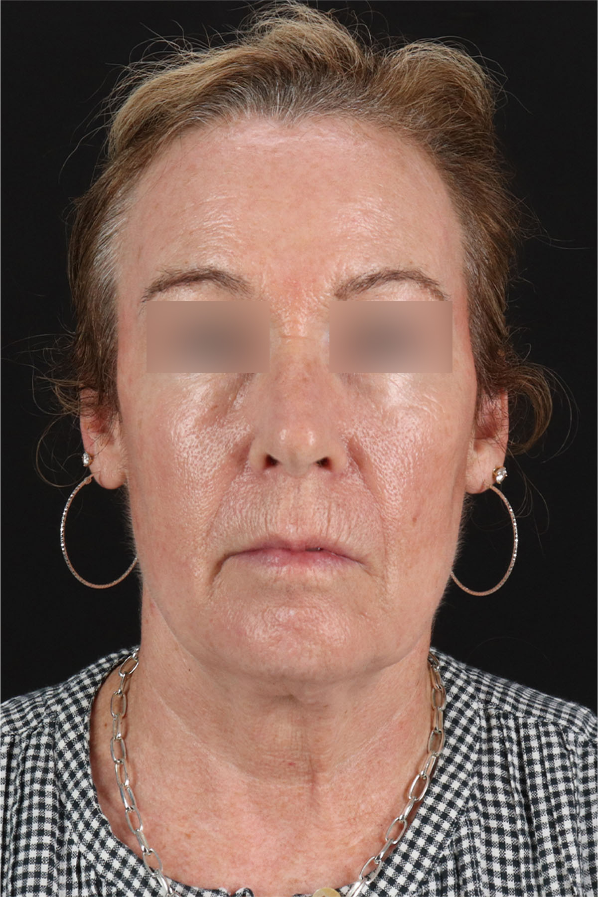 Laser Before & After Patient #3362