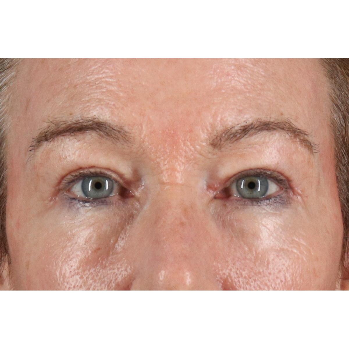 Eyelid Surgery Before & After Patient #3363